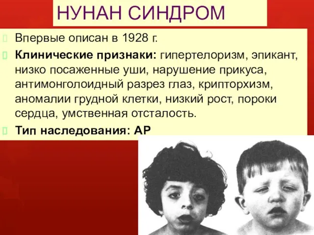 НУНАН СИНДРОМ Впервые описан в 1928 г. Клинические признаки: гипертелоризм, эпикант,