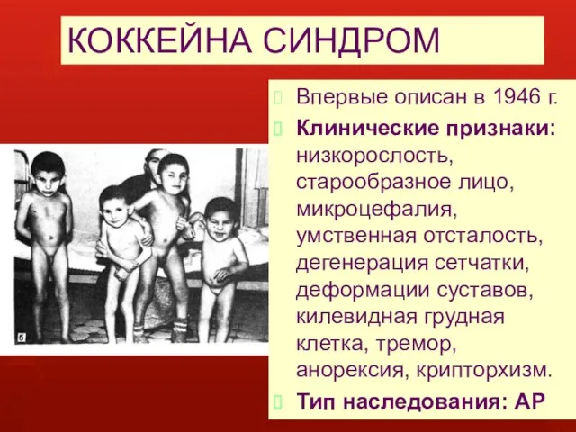 КОККЕЙНА СИНДРОМ Впервые описан в 1946 г. Клинические признаки: низкорослость, старообразное