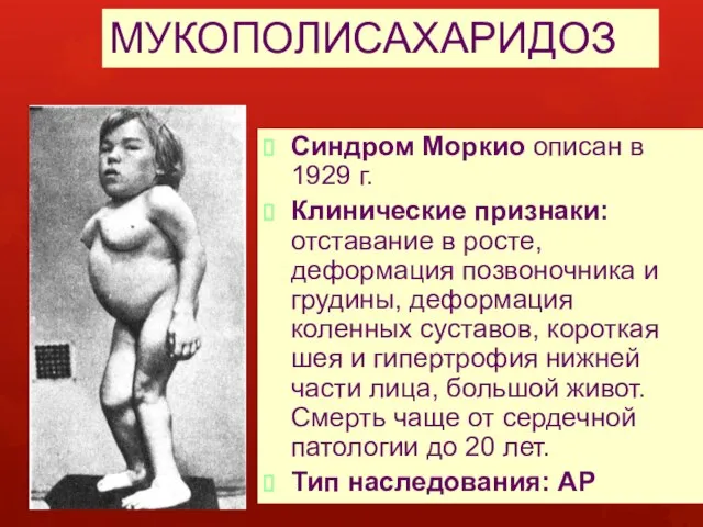 МУКОПОЛИСАХАРИДОЗ Синдром Моркио описан в 1929 г. Клинические признаки: отставание в