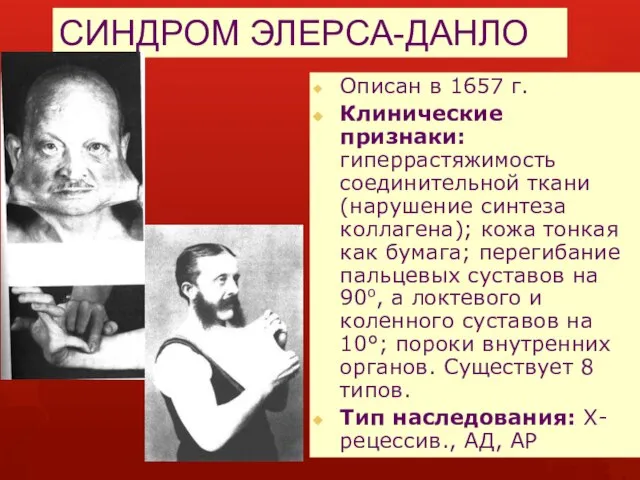 СИНДРОМ ЭЛЕРСА-ДАНЛО Описан в 1657 г. Клинические признаки: гиперрастяжимость соединительной ткани