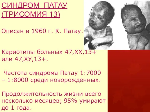 СИНДРОМ ПАТАУ (ТРИСОМИЯ 13) Описан в 1960 г. К. Патау. Кариотипы