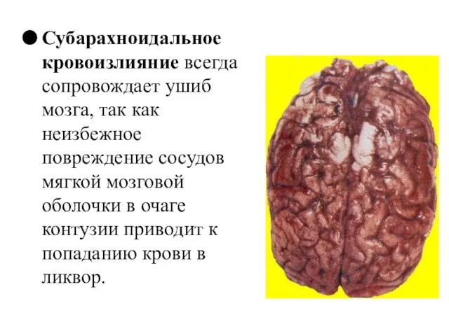 Субарахноидальное кровоизлияние всегда сопровождает ушиб мозга, так как неизбежное повреждение сосудов