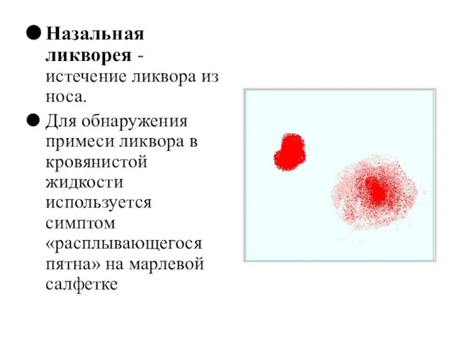 Назальная ликворея - истечение ликвора из носа. Для обнаружения примеси ликвора