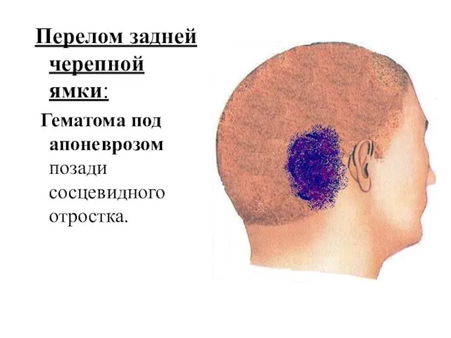 Перелом задней черепной ямки: Гематома под апоневрозом позади сосцевидного отростка.