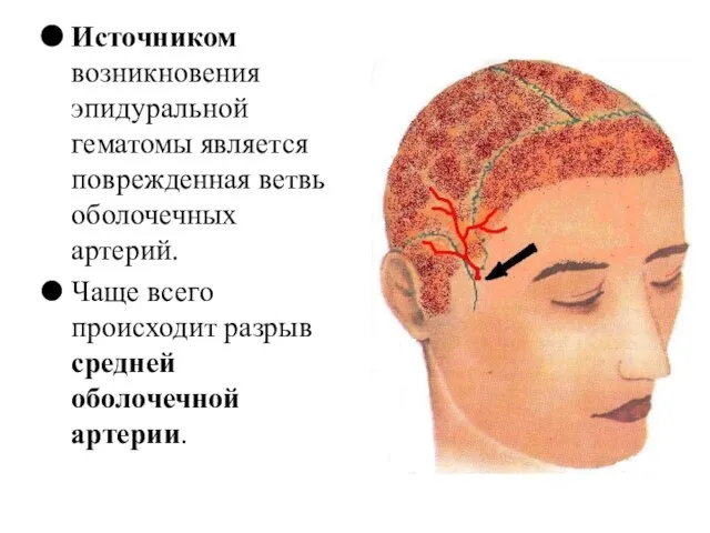 Источником возникновения эпидуральной гематомы является поврежденная ветвь оболочечных артерий. Чаще всего происходит разрыв средней оболочечной артерии.