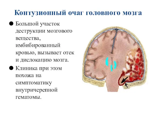 Контузионный очаг головного мозга Большой участок деструкции мозгового вещества, имбибированный кровью,