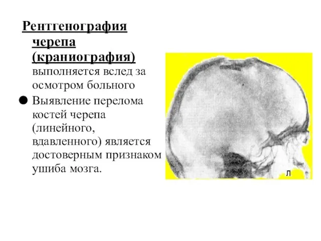 Рентгенография черепа (краниография) выполняется вслед за осмотром больного Выявление перелома костей