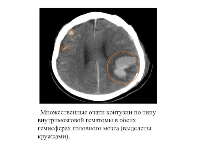 Множественные очаги контузии по типу внутримозговой гематомы в обеих гемисферах головного мозга (выделены кружками),