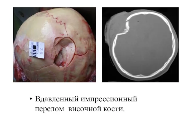 Вдавленный импрессионный перелом височной кости.