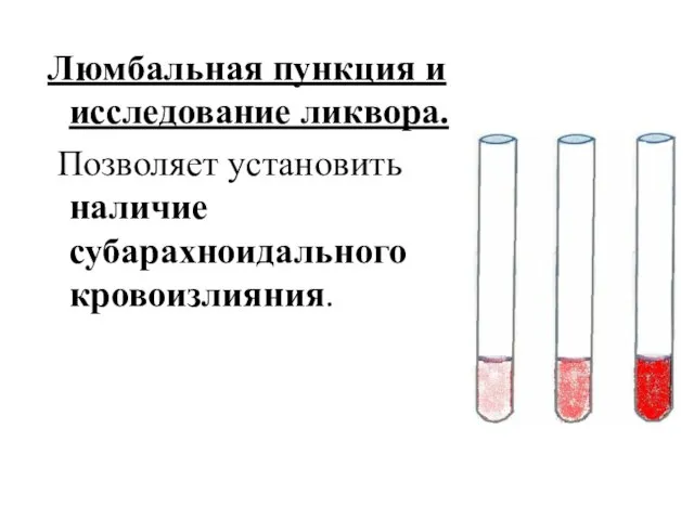 Люмбальная пункция и исследование ликвора. Позволяет установить наличие субарахноидального кровоизлияния.