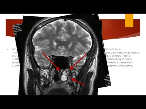 расположение Гипофиз располагается в основании головного мозга (нижней поверхности) в гипофизарной