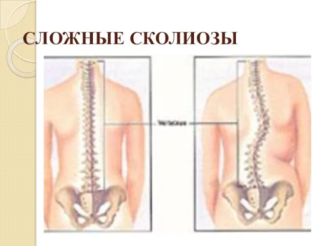 СЛОЖНЫЕ СКОЛИОЗЫ