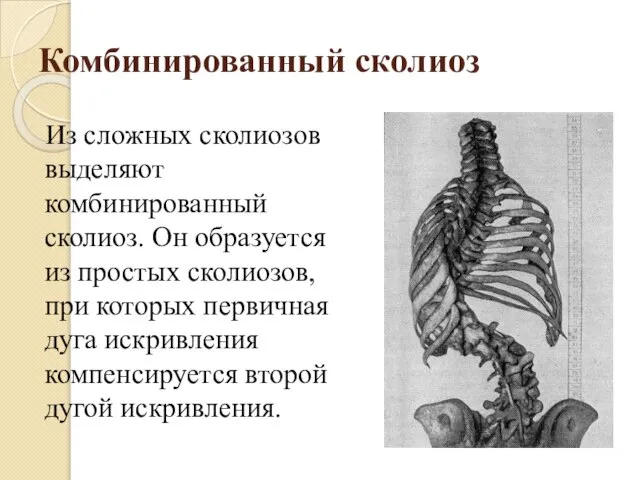 Комбинированный сколиоз Из сложных сколиозов выделяют комбинированный сколиоз. Он образуется из