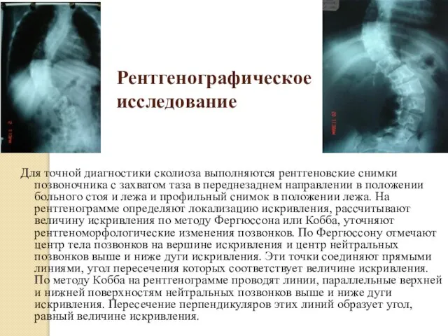 Рентгенографическое исследование Для точной диагностики сколиоза выполняются рентгеновские снимки позвоночника с