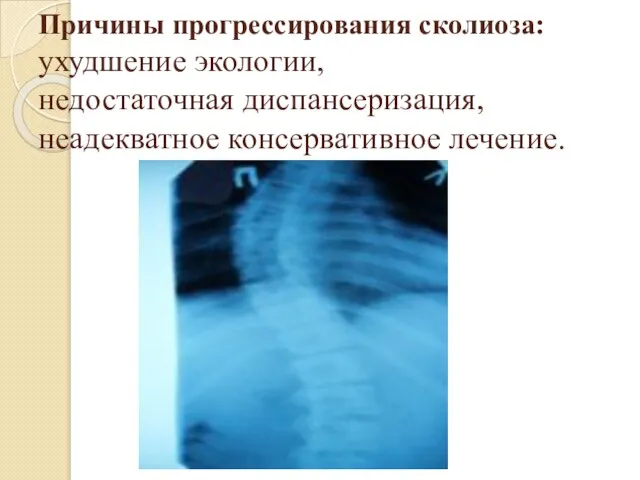 Причины прогрессирования сколиоза: ухудшение экологии, недостаточная диспансеризация, неадекватное консервативное лечение.