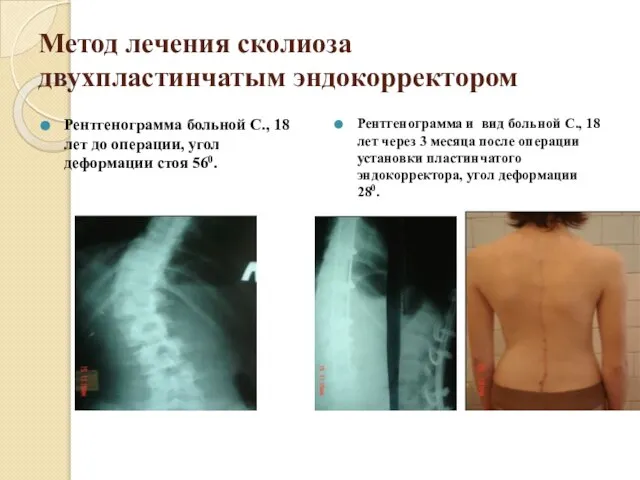 Метод лечения сколиоза двухпластинчатым эндокорректором Рентгенограмма больной С., 18 лет до