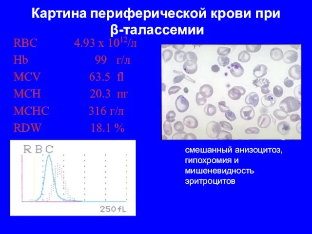 Картина периферической крови при β-талассемии RBC 4.93 x 1012/л Hb 99