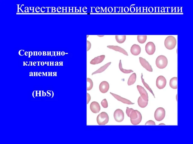 Качественные гемоглобинопатии Серповидно- клеточная анемия (HbS)