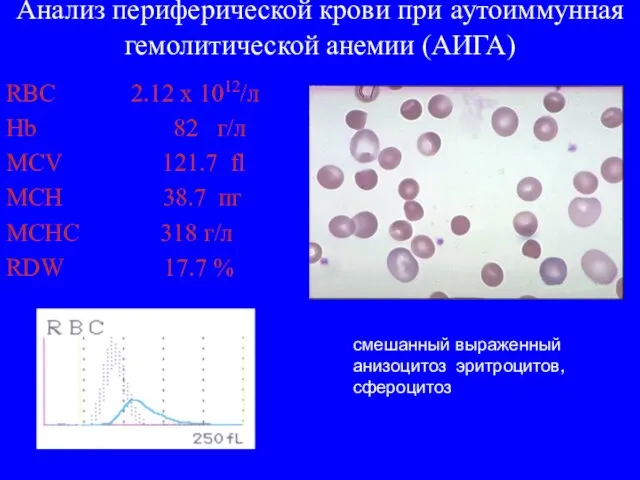 Анализ периферической крови при аутоиммунная гемолитической анемии (АИГА) RBC 2.12 x