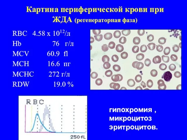 Картина периферической крови при ЖДА (регенераторная фаза) RBC 4.58 x 1012/л