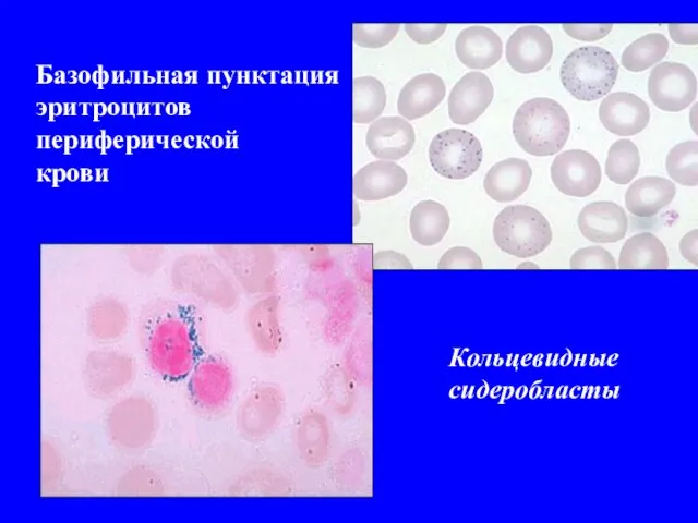 Базофильная пунктация эритроцитов периферической крови Кольцевидные сидеробласты