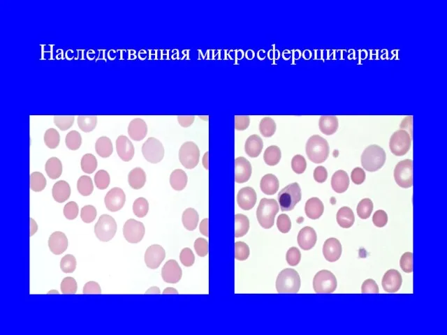 Наследственная микросфероцитарная