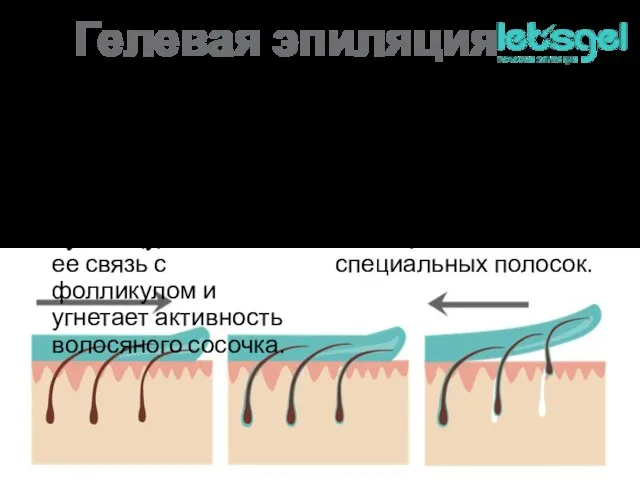 Гелевая эпиляция 1. Гель воздействует на волосяную луковицу, ослабляя ее связь