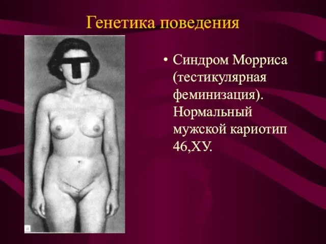 Генетика поведения Синдром Морриса (тестикулярная феминизация). Нормальный мужской кариотип 46,ХУ.