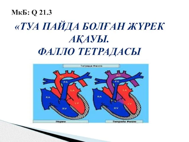 «ТУА ПАЙДА БОЛҒАН ЖҮРЕК АҚАУЫ. ФАЛЛО ТЕТРАДАСЫ МкБ: Q 21.3