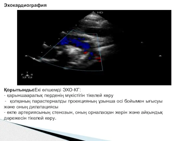 Эхокардиография Қорытынды:Екі өлшемді ЭХО-КГ: - қарыншааралық перденің мүкістігін тікелей көру қолқаның