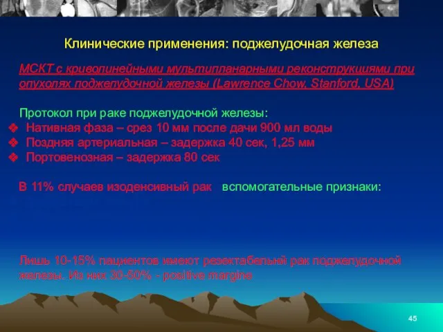 МСКТ с криволинейными мультипланарными реконструкциями при опухолях поджелудочной железы (Lawrence Chow,