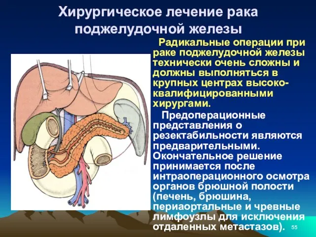 Хирургическое лечение рака поджелудочной железы Радикальные операции при раке поджелудочной железы