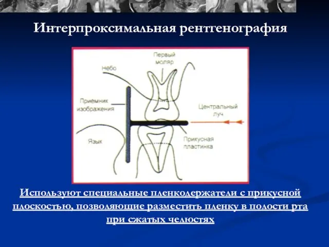 Интерпроксимальная рентгенография Используют специальные пленкодержатели с прикусной плоскостью, позволяющие разместить пленку