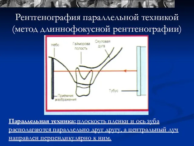 Параллельная техника: плоскость пленки и ось зуба располагаются параллельно друг другу,