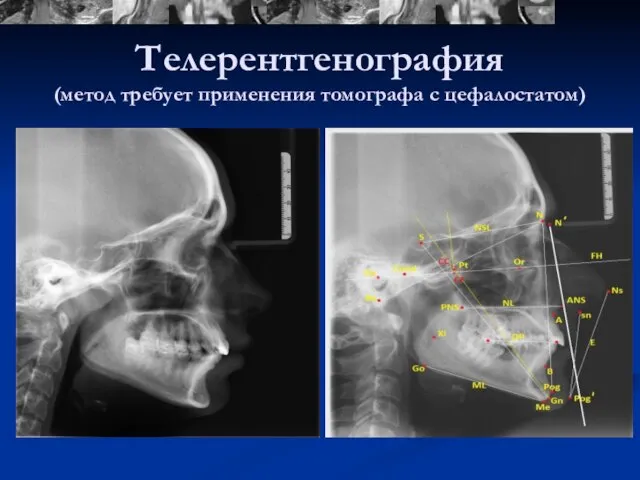 Телерентгенография (метод требует применения томографа с цефалостатом)