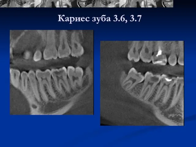 Кариес зуба 3.6, 3.7