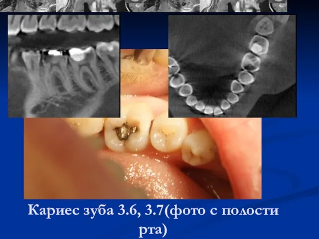 Кариес зуба 3.6, 3.7(фото с полости рта)