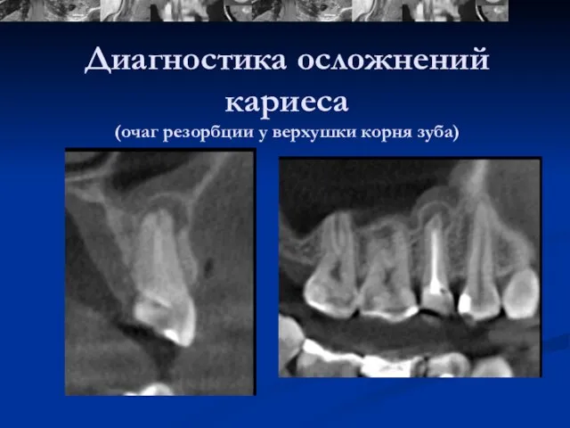 Диагностика осложнений кариеса (очаг резорбции у верхушки корня зуба)