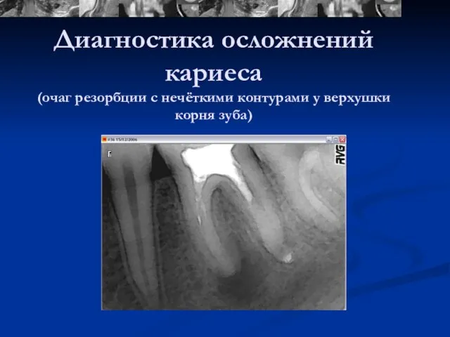 Диагностика осложнений кариеса (очаг резорбции с нечёткими контурами у верхушки корня зуба)