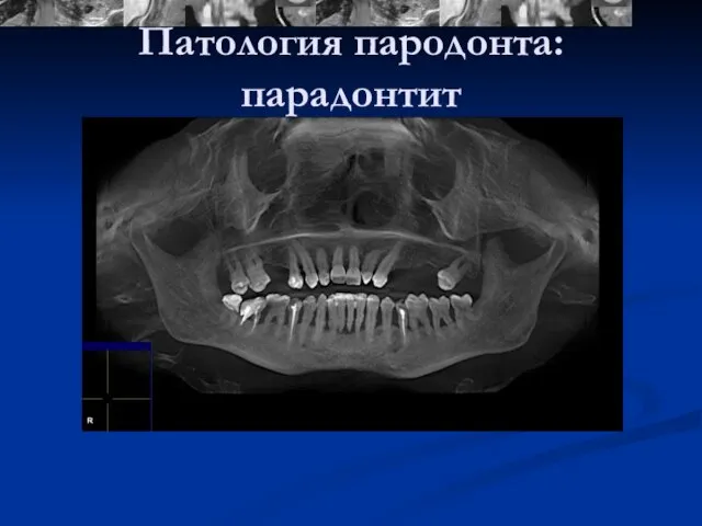 Патология пародонта: парадонтит