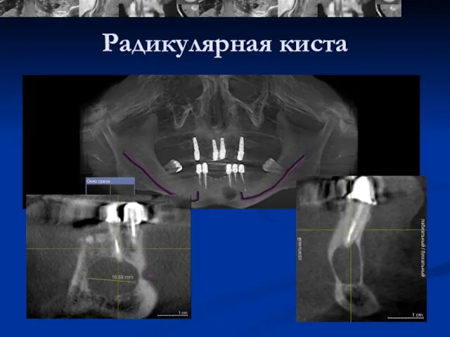 Радикулярная киста