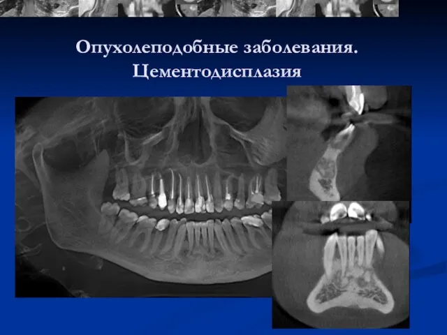 Опухолеподобные заболевания. Цементодисплазия