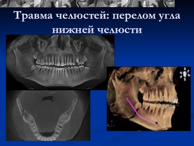 Травма челюстей: перелом угла нижней челюсти