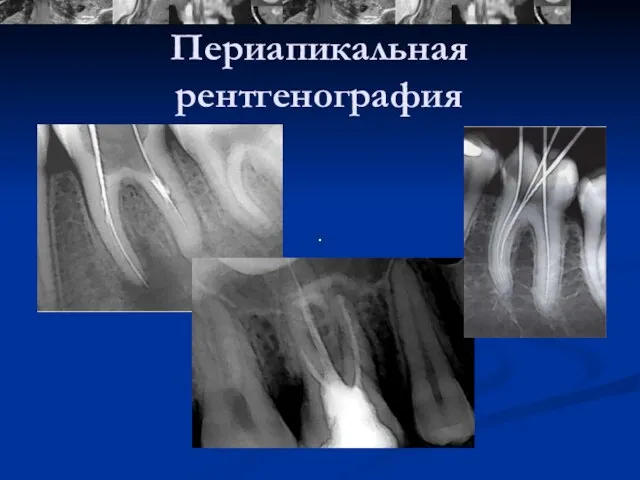 Периапикальная рентгенография