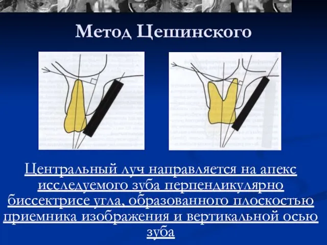 Метод Цешинского Центральный луч направляется на апекс исследуемого зуба перпендикулярно биссектрисе