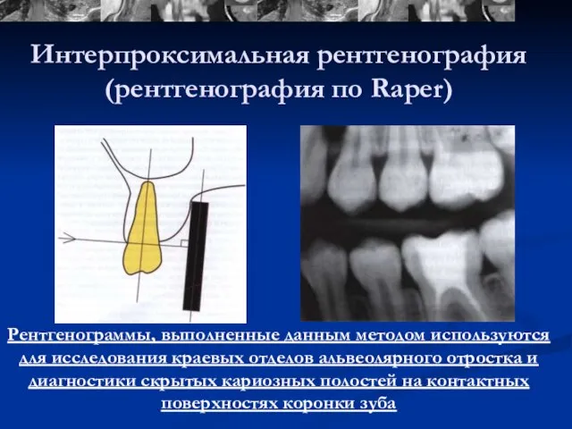 Интерпроксимальная рентгенография (рентгенография по Raper) Рентгенограммы, выполненные данным методом используются для