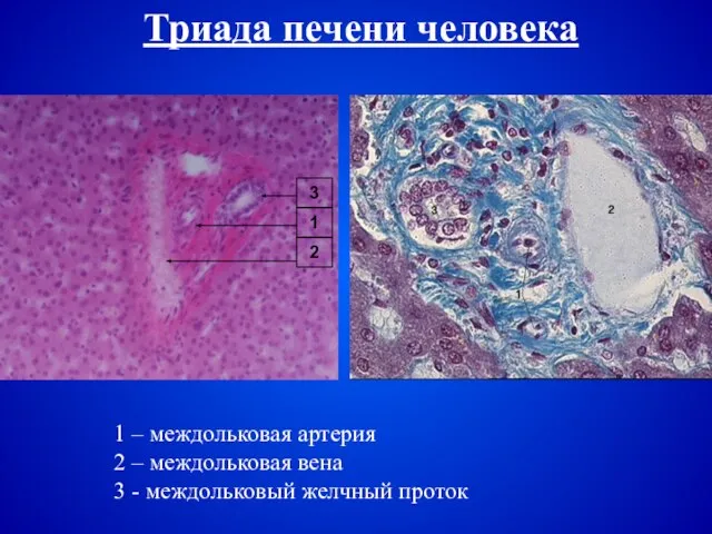 Триада печени человека 1 – междольковая артерия 2 – междольковая вена