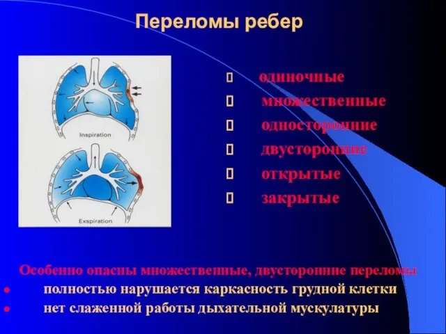 Переломы ребер одиночные множественные односторонние двусторонние открытые закрытые Особенно опасны множественные,