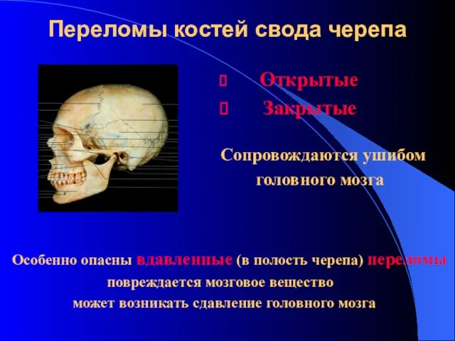 Переломы костей свода черепа Открытые Закрытые Сопровождаются ушибом головного мозга Особенно