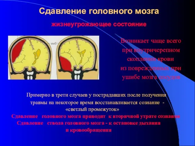 Сдавление головного мозга жизнеугрожающее состояние Возникает чаще всего при внутричерепном скоплении